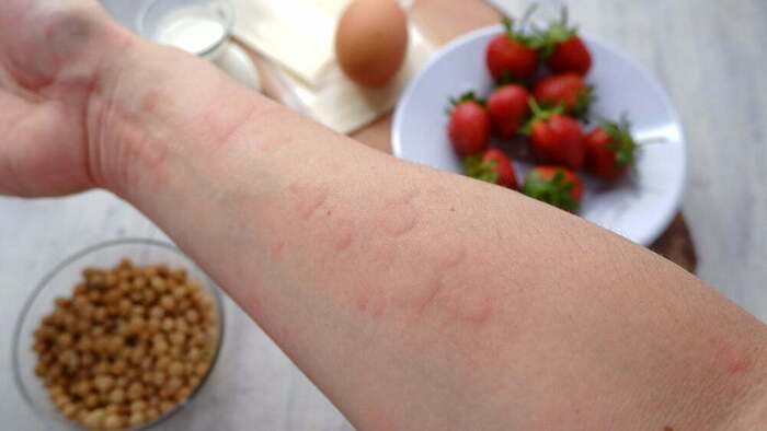 How Food Allergies Differ From Food Intolerances Explained